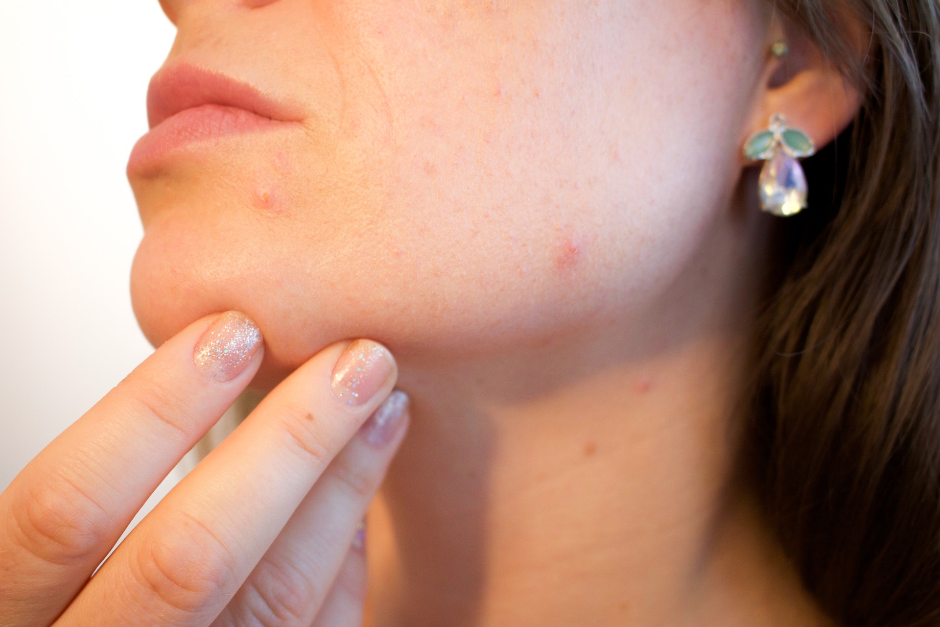 Traitement de l'acné Nice et cannes